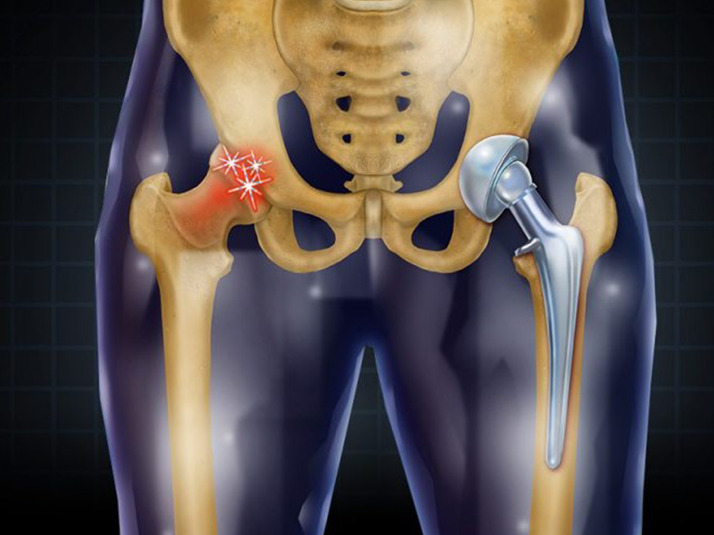Can Total Knee Replacement affect diabetes