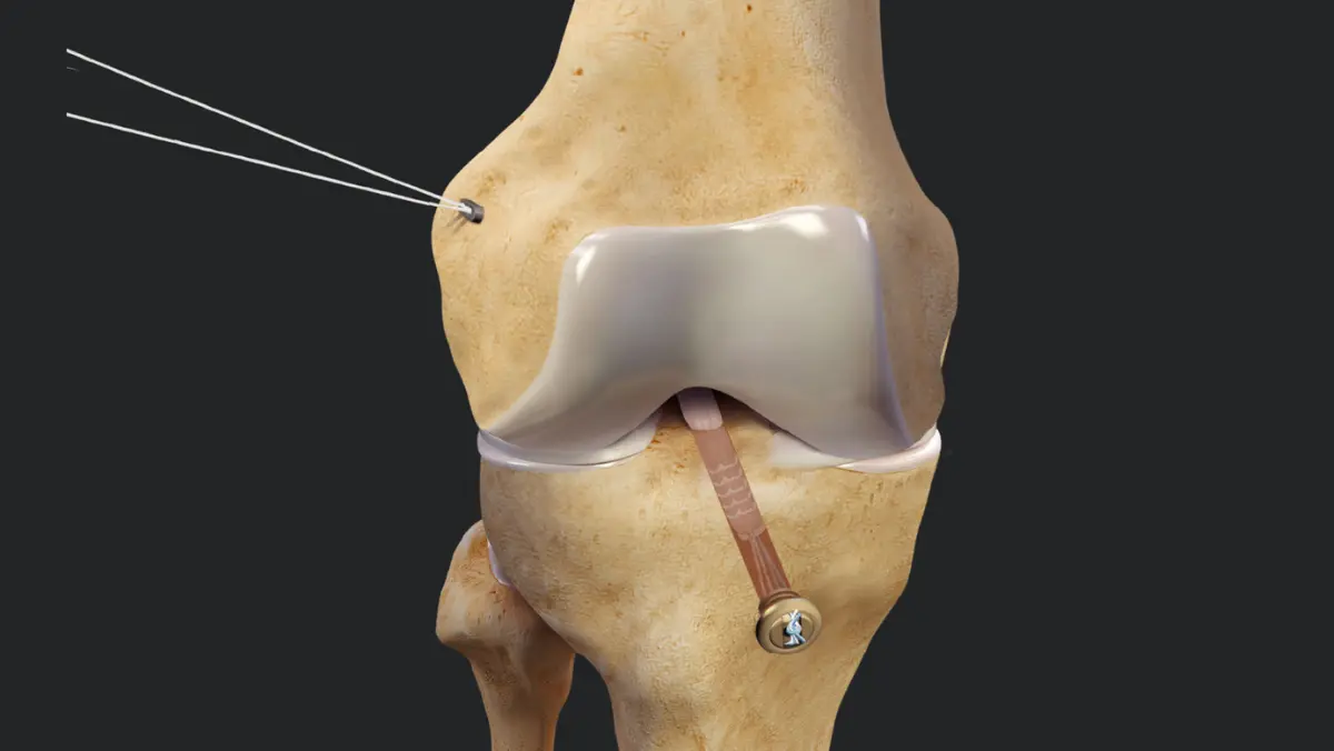 Can Total Knee Replacement affect diabetes