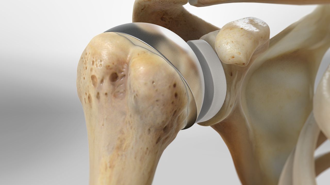 Can Total Knee Replacement affect diabetes